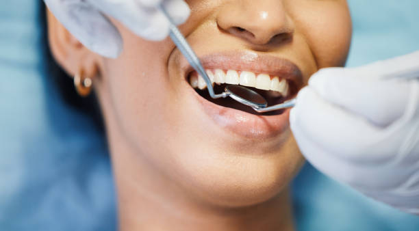 Best Knocked-Out Tooth (Avulsed Tooth) Treatment in Claremore, OK
